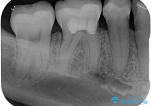 矯正の後戻りの改善と銀歯をセラミックにの治療後