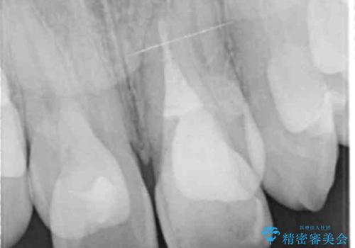 前歯が黒い セラミックで綺麗に 20代女性の治療中
