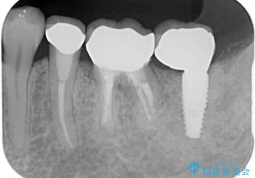 痛みを感じる奥歯 根管治療とインプラント治療の治療後