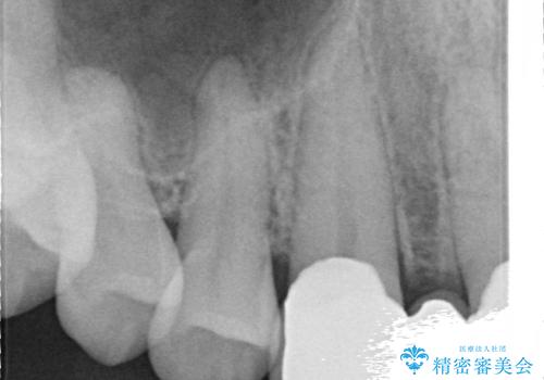 オールセラミッククラウン 部分矯正とセラミックによる前歯部の見た目の改善の治療後