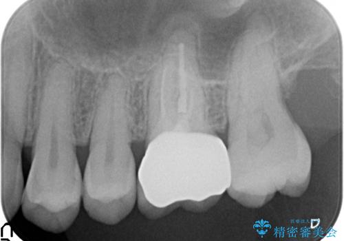 オールセラミッククラウン　咬合痛が治らない奥歯の治療の治療後