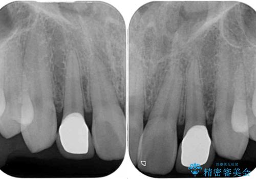 ラミネートの前歯をオールセラミッククラウンで自然にの治療後