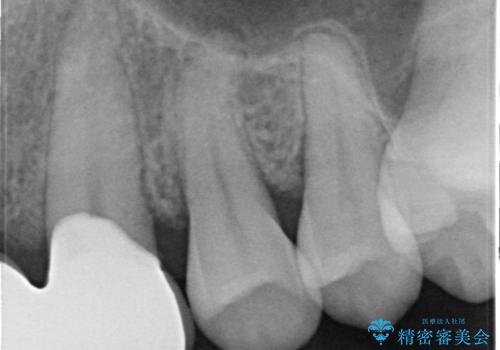 オールセラミッククラウン 部分矯正とセラミックによる前歯部の見た目の改善の治療前