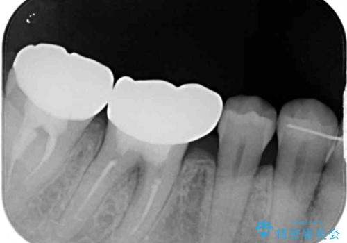 隙間だらけの歯列をきれいに インビザライン矯正とセラミック補綴治療の治療後