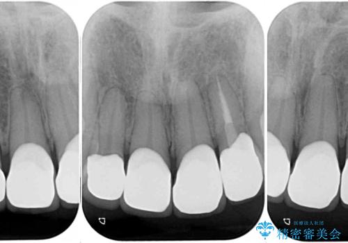 矯正しても虫歯が気になる 前歯のオールセラミッククラウンの治療後