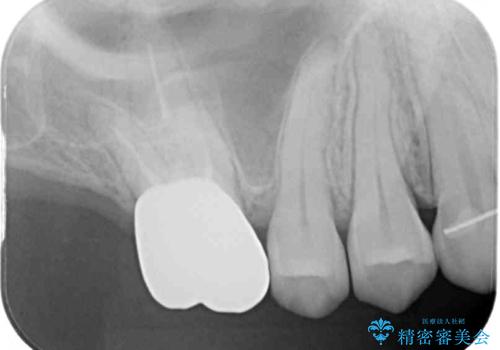 隙間だらけの歯列をきれいに インビザライン矯正とセラミック補綴治療の治療後