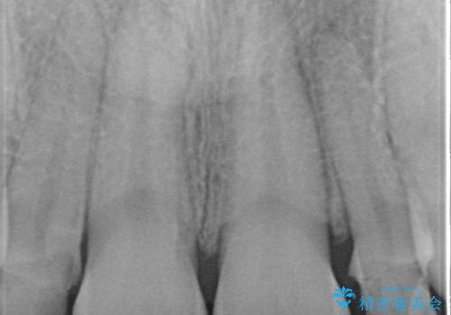 前歯を整えたい 小さい前歯がある 矯正・セラミック併用で美しく インビザラインでも抜歯矯正できますの治療中