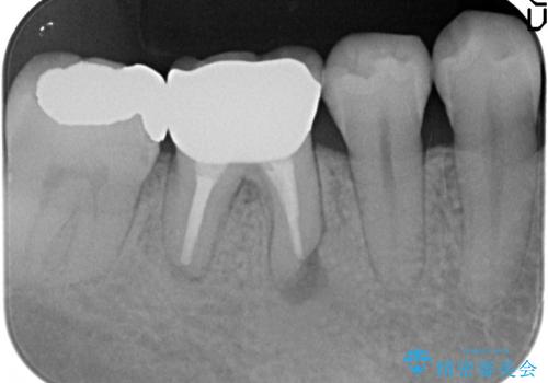 オールセラミッククラウン 膿が出続ける根の治療の治療後