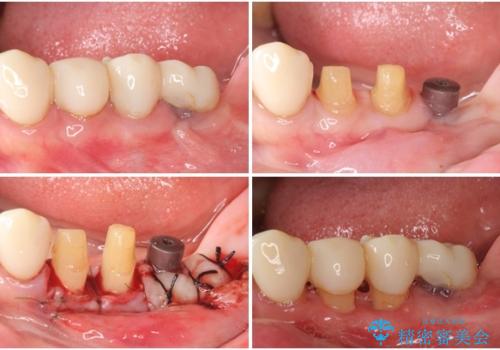 歯周病改善のための総合歯科治療の治療中