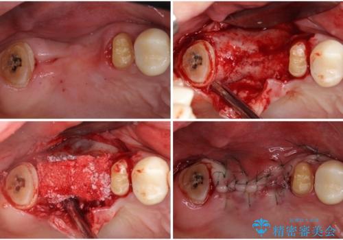 歯周病改善のための総合歯科治療の治療中