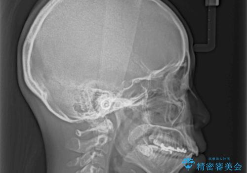 前歯の突出を軽減 インビザラインによる抜歯矯正の治療前