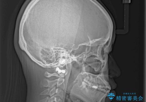 隙間の空いた前歯を治したい インビザライン矯正治療の治療前