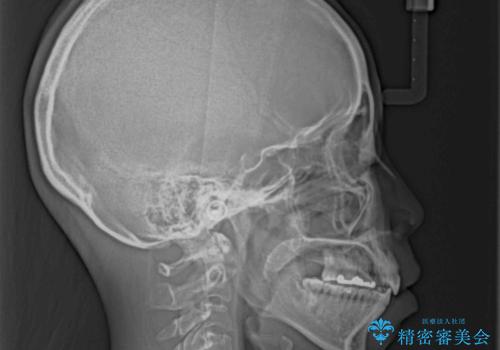 前歯の突出を軽減 インビザラインによる抜歯矯正の治療後