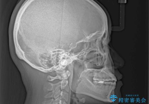 隙間の空いた前歯を治したい インビザライン矯正治療の治療後