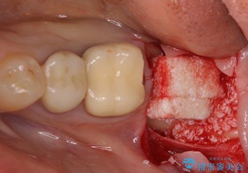 痛みを感じる奥歯 根管治療とインプラント治療の治療後