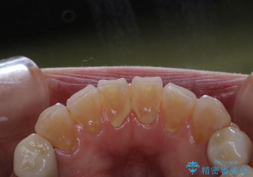 口臭予防のため歯科医院での歯の掃除 PMTCの治療前