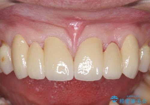 オールセラミッククラウン 部分矯正とセラミックによる前歯部の見た目の改善の治療後
