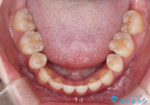 ワイヤーによる出っ歯の矯正　前歯でかめるようにの治療後