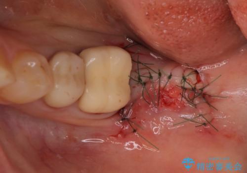 痛みを感じる奥歯 根管治療とインプラント治療の治療前