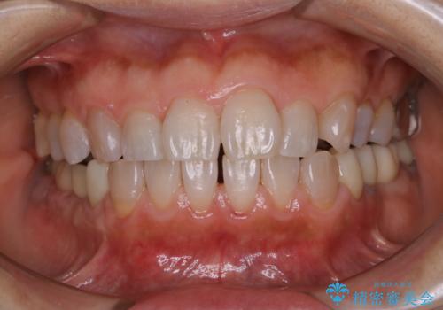 口臭予防のため歯科医院での歯の掃除　PMTCの治療後