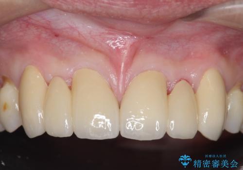 オールセラミッククラウン 部分矯正とセラミックによる前歯部の見た目の改善の治療後