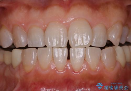 口臭予防のため歯科医院での歯の掃除 PMTCの症例 治療後