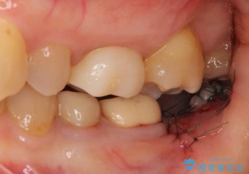 痛みを感じる奥歯 根管治療とインプラント治療の治療中