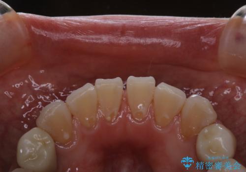 口臭予防のため歯科医院での歯の掃除 PMTCの治療後
