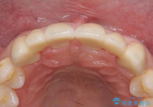 オールセラミッククラウン 部分矯正とセラミックによる前歯部の見た目の改善の治療後