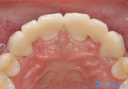 オールセラミッククラウン 部分矯正とセラミックによる前歯部の見た目の改善の治療後