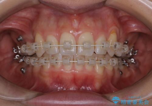 ワイヤー矯正中のPMTCの治療前