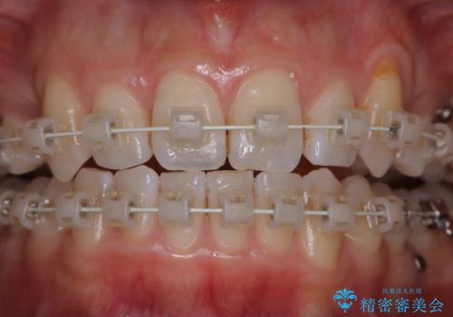 ワイヤー矯正中のPMTCの治療前