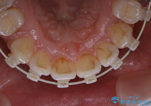 ワイヤー矯正中のPMTCの治療前