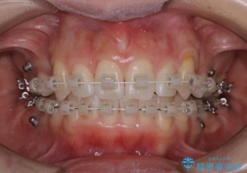 ワイヤー矯正中のPMTCの治療後