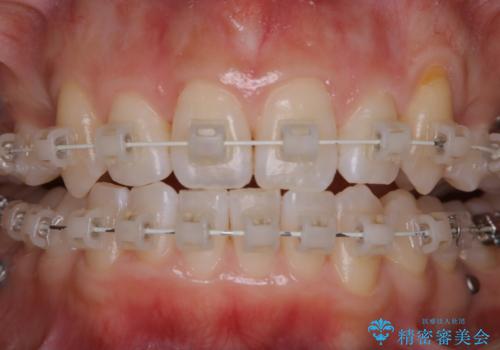 ワイヤー矯正中のPMTCの治療後