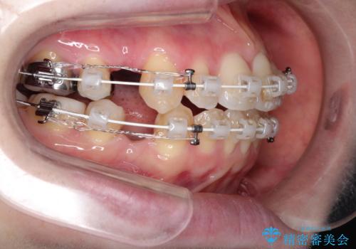 ワイヤーによる出っ歯の矯正　前歯でかめるようにの治療中