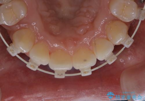 ワイヤー矯正中のPMTCの治療後