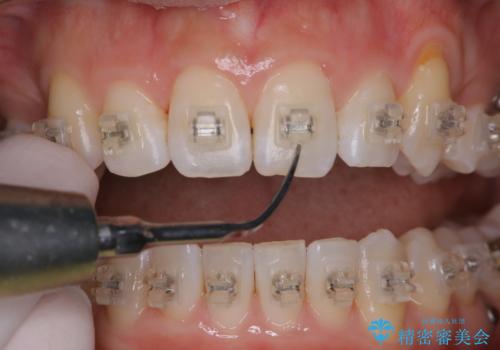 ワイヤー矯正中のPMTCの治療中