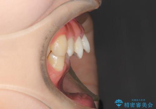 重度のガタガタのインビザラインによる非抜歯矯正の治療前