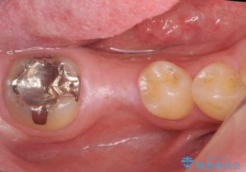 初めてのインプラント 手術は怖いので、寝ている間に終わりたいの治療前