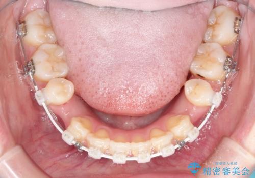 ワイヤーによる出っ歯の矯正　前歯でかめるようにの治療中