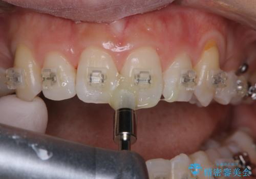 ワイヤー矯正中のPMTCの治療中