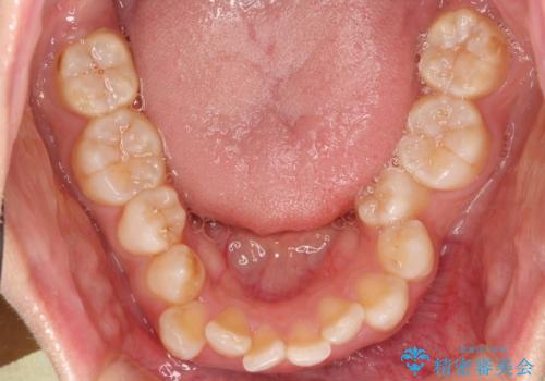 重度のガタガタのインビザラインによる非抜歯矯正の治療前