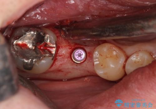 初めてのインプラント 手術は怖いので、寝ている間に終わりたいの治療中