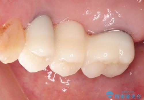 奥歯がなくなり咬めない インプラント治療による咬み合わせの回復の治療後