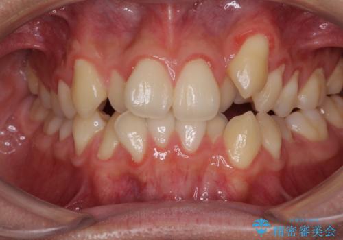 八重歯を治したい 目立たないワイヤー装置での抜歯矯正の症例 治療前