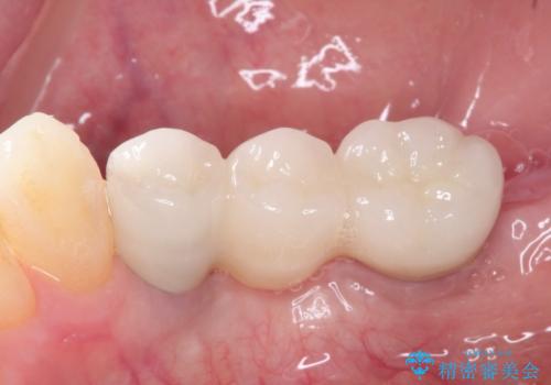 奥歯がなくなり咬めない インプラント治療による咬み合わせの回復の治療後