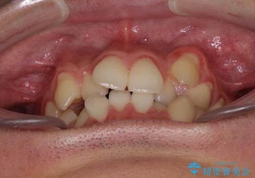 八重歯を治したい 目立たないワイヤー装置での抜歯矯正の治療前