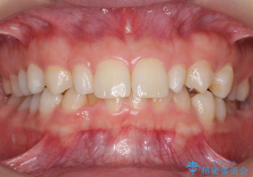 前歯を整えたい　小さい前歯がある　矯正・セラミック併用で美しく　インビザラインでも抜歯矯正できますの症例 治療前
