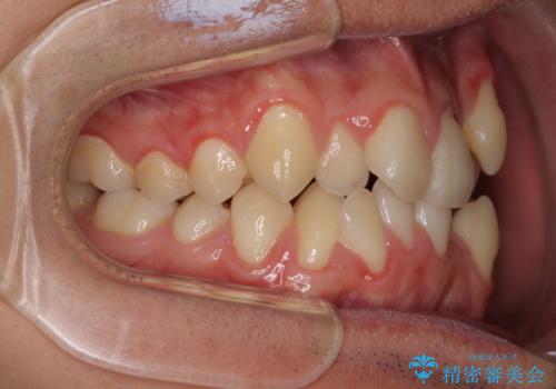 八重歯を治したい 目立たないワイヤー装置での抜歯矯正の治療前